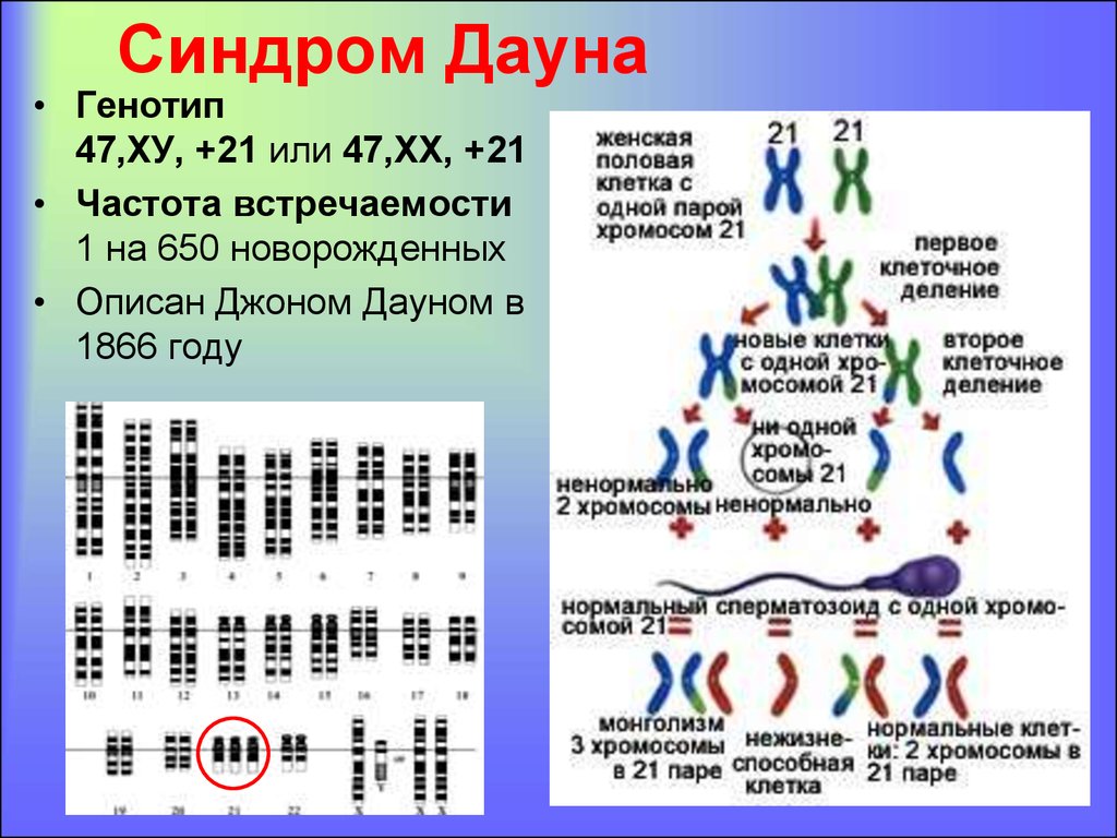 Назовите число хромосом. Мозаичный Тип синдрома Дауна кариотип. Кариотип синдрома Дауна формула. Механизм возникновения синдрома Дауна. Синдром Дауна хромосомная карта.